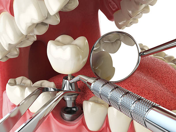 Best Lost Filling or Crown Replacement in Churchill, OH